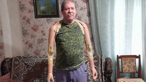 Протезы обеих рук, тяговые, обзор и их функционал