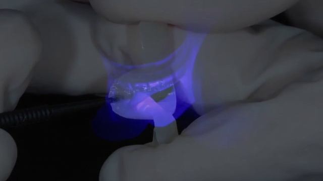 Implant supported provisional смотреть онлайн