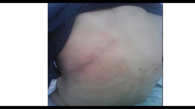 Bronchiectasis and Lobectomy смотреть онлайн