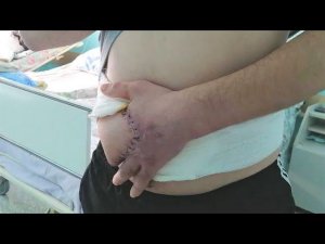 В Сургуте хирурги пришили руку к животу пациента