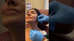 Radiesse neck lift