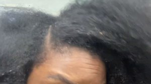 DANDRUFF SCRATCHING | Dry Itchy Scalp (Part 1)