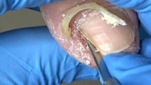 Ingrown nails curled into sharp corners, surprised!【Xue Yidao】