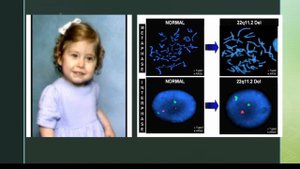 Синдром Ди Джорджи