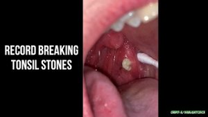 Tonsil Stones, Tonsil, Tonsil Stone Removal Tools