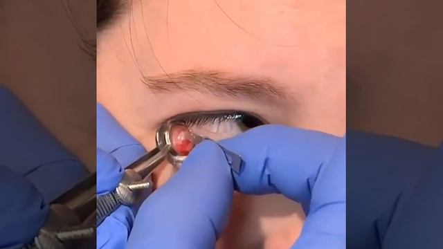 Халязион смотреть онлайн