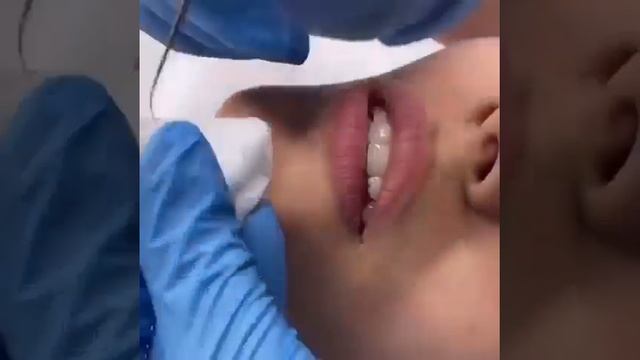 Удаление гранул Фордайса в Medicris. Кропотливая, ювелирная работа