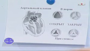 Порок  сердца / Главный внештатный интервенционный кардиолог и инвазивный аритмолог Дамир Осмонов
