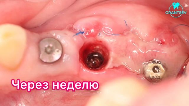 Наращивание десны. Расщепленный лоскут. Вестибулярное смещение расщепленного лоскута.