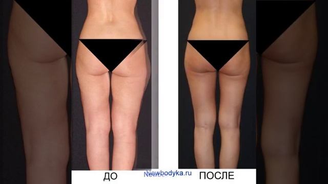 Уменьшение бедер. Уши на бедрах. Липофилинг ягодиц до и после. Баттерфляй операция подтяжка ягодицы. Лпж галифе.
