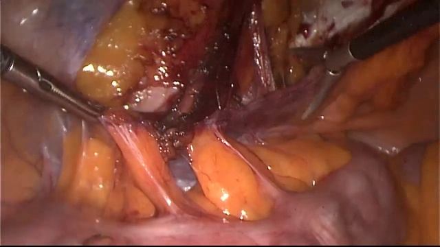 Лапароскопическая герниопластика ТАРР - 6 смотреть онлайн