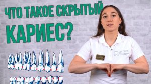 Скрытый кариес и где он обитает