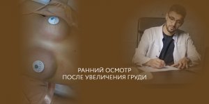 Увеличение груди // Как выглядит шов через две недели после маммопластики