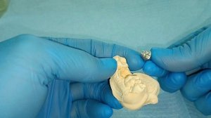 протезирование зубов