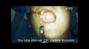 Infiltration Anaesthesia for Sinus Lifting  Right side.