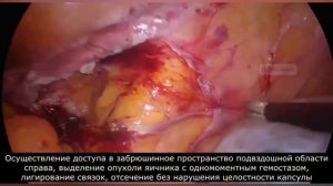 Срочная гистология при опухолях яичника.