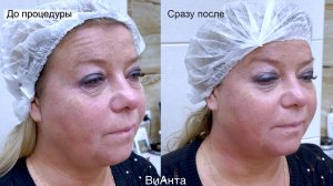 Смас-лифтинг - Безоперационная ультразвуковая подтяжка Liftera-A