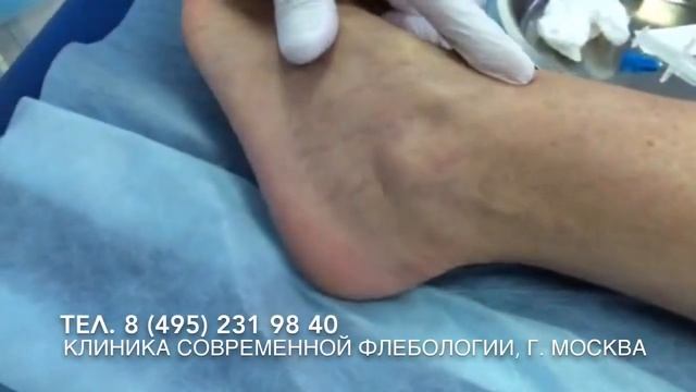 Склеротерапия, удаление сосудистых звездочек, флеболог Дробязго Сергей, г. Москва