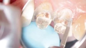 Препарирование зубов под коронки. Часть1