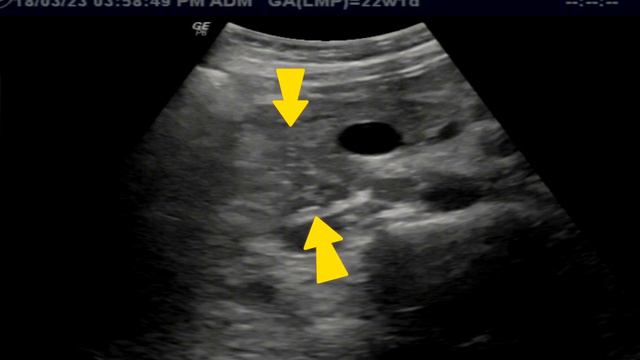 Ultrasound Pancreatic Cancer | Billiary Obstruction | Risk Factors | Prognosis смотреть онлайн