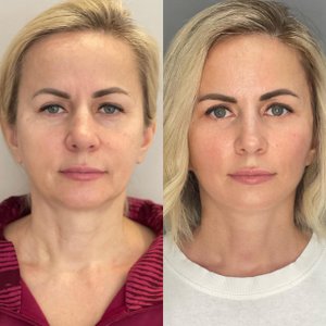 Спустя 3 месяца после подтяжки лица.