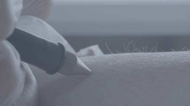 Электроэпиляция и лазерная эпиляция смотреть онлайн