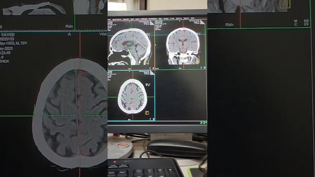 Generalized Cerebral cortical atrophy with mild maxillary sinusitis.