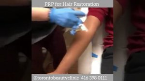 PRP for Hair restoration