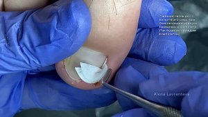 Сюрприз после хирурга /  Вросший ноготь пробил боковой валик / Удаления вросшего ногтя у хирурга