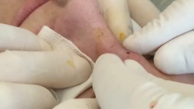 Squeezing pimple , cyst, boil!! Брызгающий Прыщ фурункул!!!
