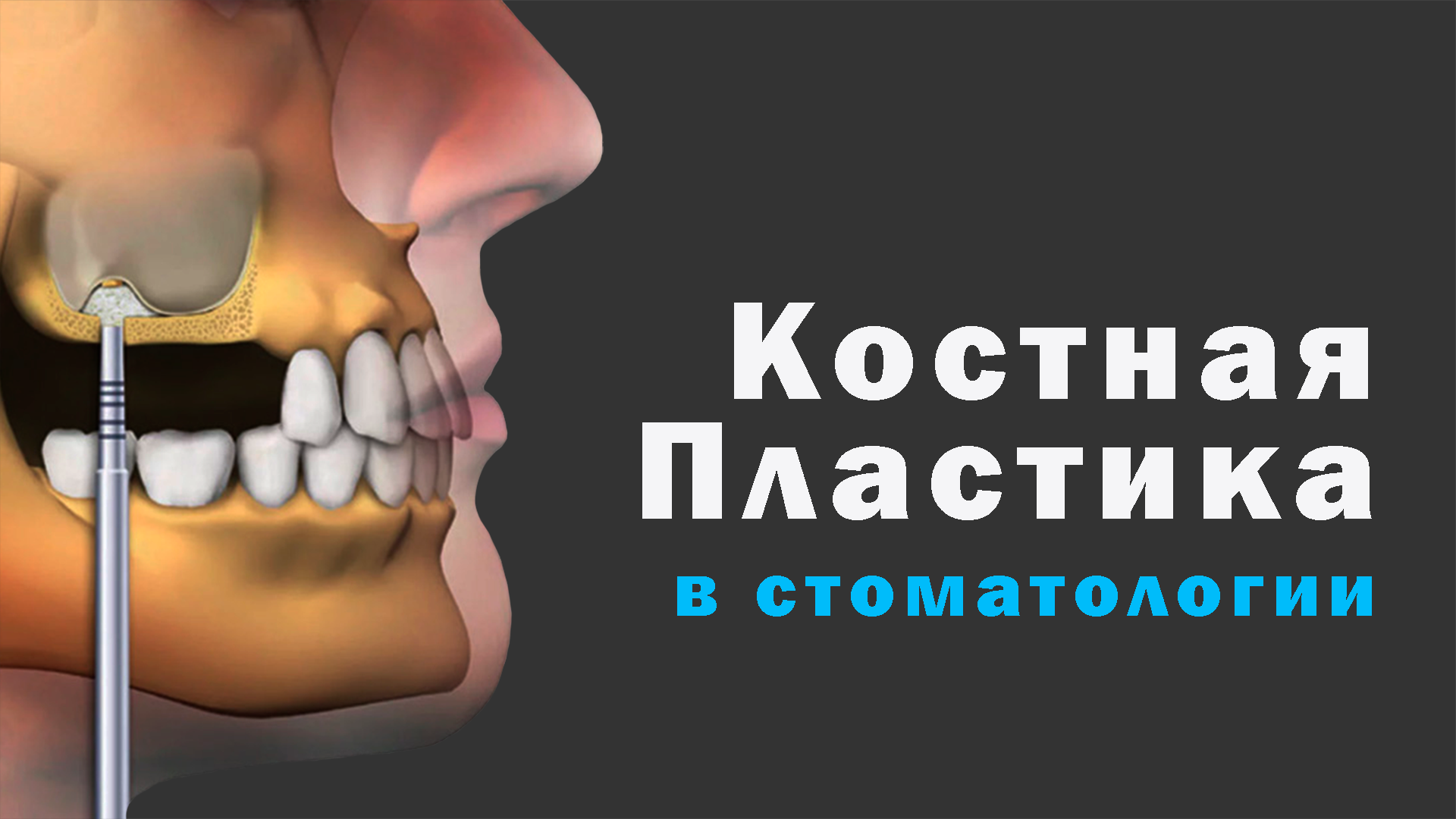 После костной пластики фото Вертикальная костная пластика после отмены бифосфонатов (2937) - Хирургия - Ново