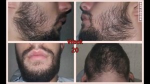 Миноксидил для бороды - ДО ПОСЛЕ РЕЗУЛЬТАТ за 9 месяцев