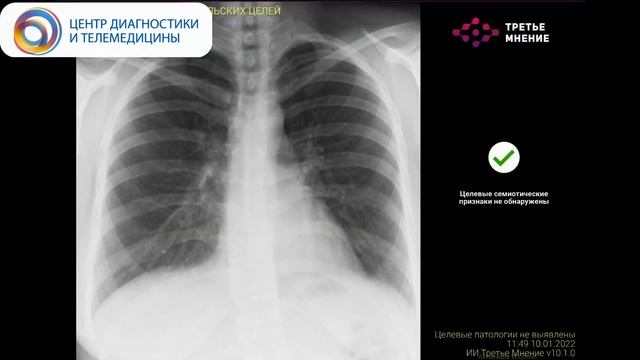 ИИ-сервис для диагностики признаков патологии ОГК при РГ ОГК и флюорографии легких ТРЕТЬЕ МНЕНИЕ смотреть онлайн