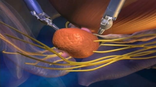 Приложение на робота Да Винчи в урологията смотреть онлайн