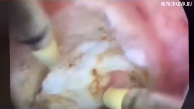 Субмукозная миома. Гистерорезектоскопическая миомэктомия