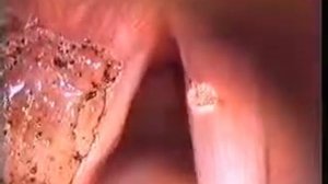 Папилломатоза гортани