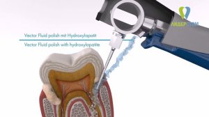 Ультразвуковая чистка зубов щадящая с продольным движением скалера аппаратом Вектор ПараПро