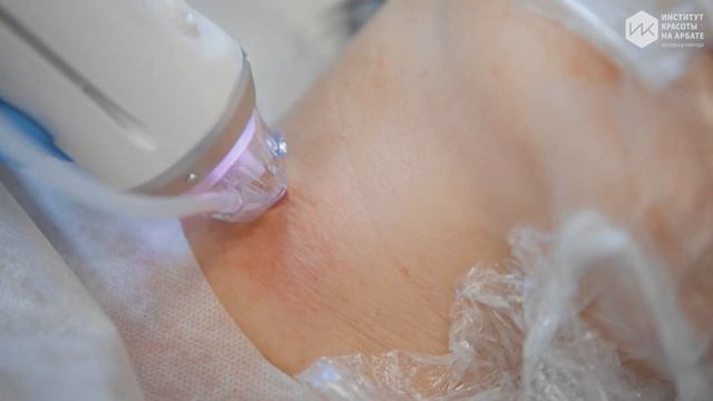 RF-лифтинг на аппарате ELLISYS SENSE смотреть онлайн