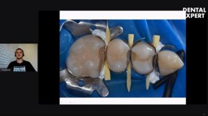 Гордийчук   модуль1 Восстановление контактного пункта в технике прямой реставрации