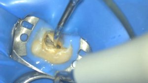 удаление дентикля и карниза в верхней моляре