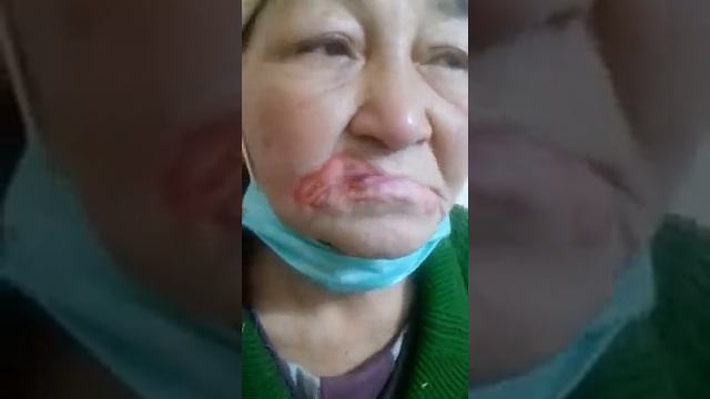 Экзема