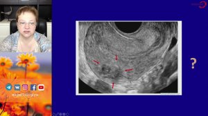 Экспертология | Сочетанная патология: миома + аденомиоз
