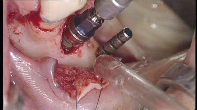 УСТАНОВКА ИМПЛАНТАТА С НКР ПОСЛЕ УДАЛЕНИЯ ПРЕМОЛЯРОВ Н/Ч. ОДНОМОМЕНТНАЯ УСТАНОВКА. ЗАЖИВЛЕНИЕ ТКАНЕ смотреть онлайн