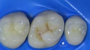 фантомная композитная реставрация верхнего шестого зуба (16 tooth phantom composite restoration)