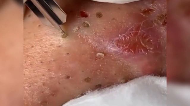 Спорим, ты любишь делать это ! trash compilation | squeezing pus | выдавливание черных точек смотреть онлайн