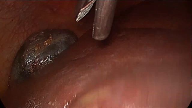 Варианты сосудистой анатомии при выполнении лапароскопической холецистэктомии смотреть онлайн