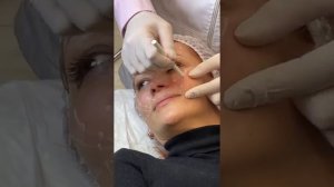 Atlantis Lift Техника Итальянский лифтинг