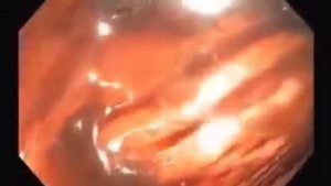 Кишечник здорового и больного человека.