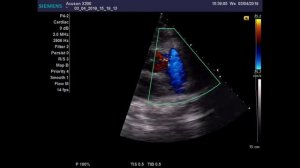 коронарно легочная фистула