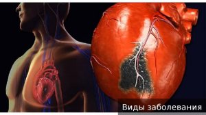 острый инфаркт миокарда